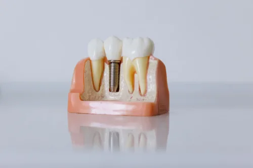 close up shot of dental implant model